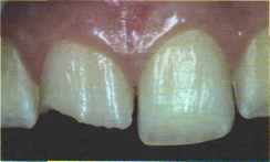 Recrearea unui model optic tridimensional al țesuturilor dentare, dentar-siberian