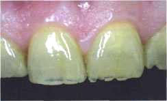 A fogászati ​​szövetek háromdimenziós optikai modellje, fogászati-szibériai