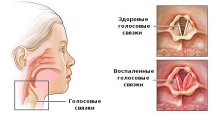 Etiologia esofagitei de reflux cronică și variabilitatea tratamentului