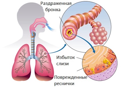 Etiologia esofagitei de reflux cronică și variabilitatea tratamentului