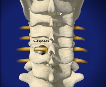 Foraminotomia cervicală posterioară