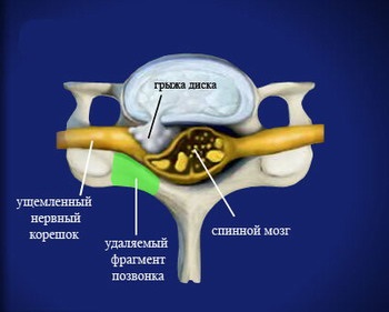 Foraminotomia cervicală posterioară