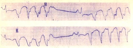 Kamrai paroxysmal tachycardia - útmutató a gyermek klinikai elektrokardiográfiájához