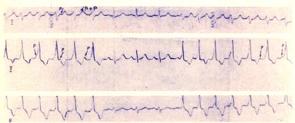 Kamrai paroxysmal tachycardia - útmutató a gyermek klinikai elektrokardiográfiájához