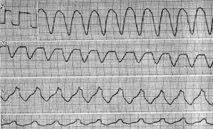 Tahicardie paroxistică ventriculară (ecg cu tahicardie paroxistică ventriculară dreaptă) -