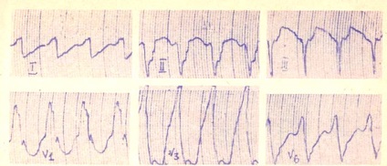 Tahicardia paroxistică ventriculară - ghid pentru electrocardiografia clinică a unui copil