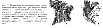 Abces, flegmon din spațiul okolohlotchnogo - un bun portal dentar, bun