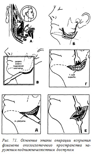 Abces, flegmon din spațiul okolohlotchnogo - un bun portal dentar, bun