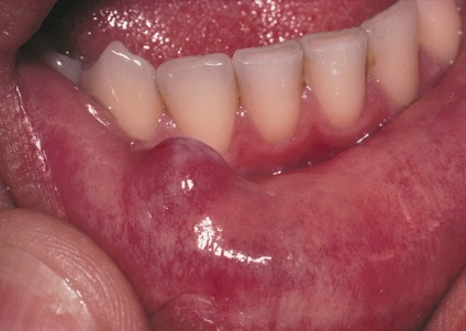 Absența cauzelor buzelor și a metodelor de tratament