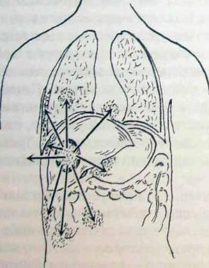 Abcesul ficatului