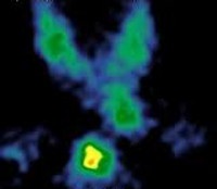 Parathyroid adenoma - okok, tünetek, diagnózis és kezelés