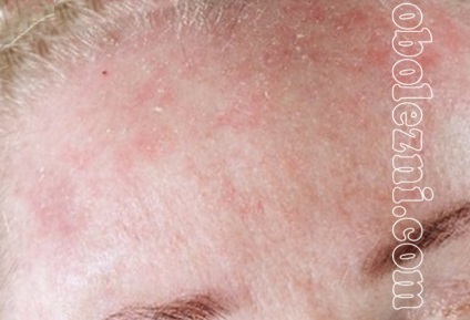 Dermatita alergică - fotografii ale manifestărilor pe diferite părți ale corpului