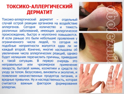 Dermatita alergică - fotografii ale manifestărilor pe diferite părți ale corpului
