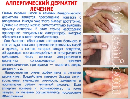 Dermatita alergică - fotografii ale manifestărilor pe diferite părți ale corpului