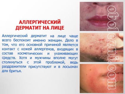 Dermatita alergică - fotografii ale manifestărilor pe diferite părți ale corpului