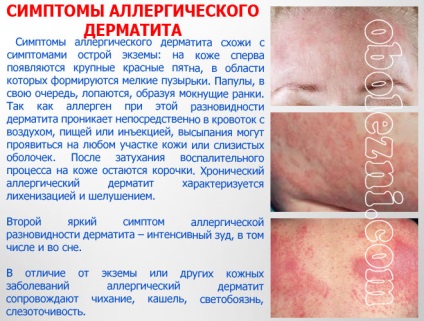 Dermatita alergică - fotografii ale manifestărilor pe diferite părți ale corpului