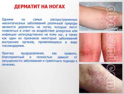 Dermatita alergică - fotografii ale manifestărilor pe diferite părți ale corpului