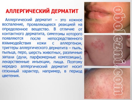 Dermatita alergică - fotografii ale manifestărilor pe diferite părți ale corpului