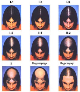 Androgén alopecia (hajhullás) nőknél, kezelés