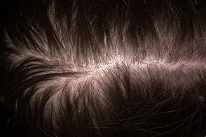 Androgén alopecia (hajhullás) nőknél, kezelés