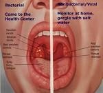 Angina (amigdalita) - diagnosticarea, prevenirea și tratamentul amigdalei (tonzilita)