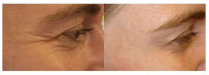 Imagini Botox, puncte de setare, riduri, recomandări, acțiune