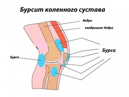 Bursita simptome articulare genunchi și tratament