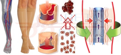 Centrul de flebologie - bandaj elastic