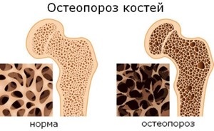 Centrul de Osteoporoza - Clinica a Institutului de Limfologie