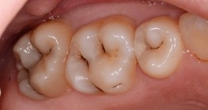 Sensibilitatea dinților și a gingiilor cauzează și remedii împotriva hiperesteziei