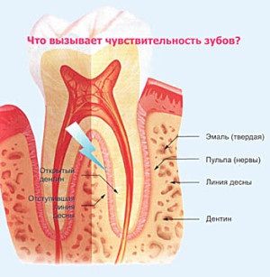 Sensibilitatea dinților și a gingiilor cauzează și remedii împotriva hiperesteziei