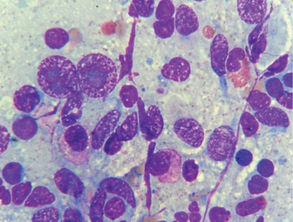 Diagnosticul cytologic al limfomului Hodgkin din material fibrobronchoscopic (observație de la