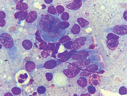 Diagnosticul cytologic al limfomului Hodgkin din material fibrobronchoscopic (observație de la