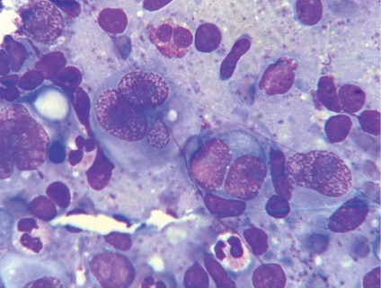 Diagnosticul cytologic al limfomului Hodgkin din material fibrobronchoscopic (observație de la