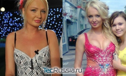 Дария Pynzar трябваше пластична хирургия (уголемяване на гърдите) - Преди & След снимки