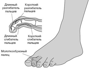 A lábujjak deformitása (kalapács, karomszerű)