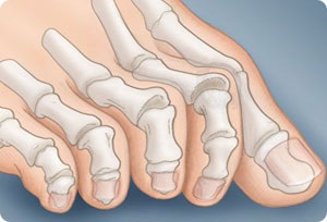 A lábujjak deformitása (kalapács, karomszerű)