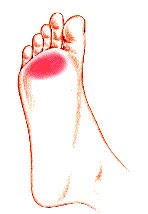 Deformări ale degetelor de la picioare (ciocane, gheare)