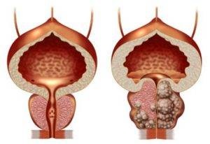 A prosztata diffúz változásai és diffúz hyperplasia, ami diffúz változások a