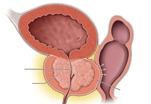 A prosztata diffúz változásai és diffúz hyperplasia, ami diffúz változások a