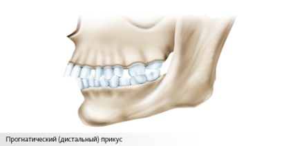 Tratamentul ocluzional (prognostic) distal, provoacă, înainte și după