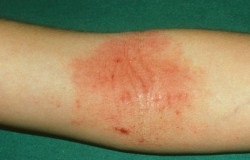 Eczemă - simptome și tratament cu remedii folclorice