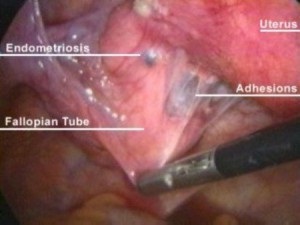 Endometrioza cauzei bolii uterului