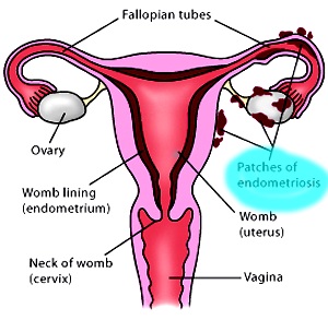 Endometrioza cauzei bolii uterului