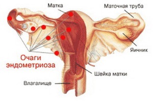 Endometrioza cauzei bolii uterului