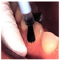 Fluorizarea dinților este o metodă exogenă de prevenire a cariilor