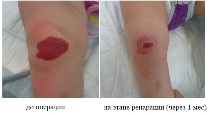 Hemangioma - eltávolítás gyermekeknél és felnőtteknél, műtét ára, Szentpétervár