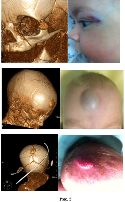 Hemangioma - eltávolítás gyermekeknél és felnőtteknél, műtét ára, Szentpétervár