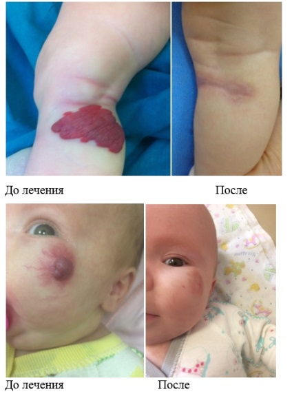 Hemangiomul - îndepărtarea la copii și adulți, prețul chirurgiei, Sankt Petersburg