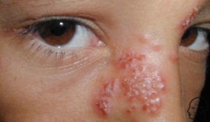 Herpesul pe față - cum se vindecă rapid cauzele și simptomele